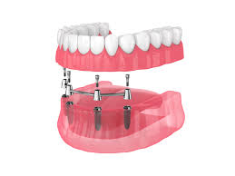 abutments